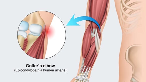 Golfer's elbow (pain on the inside)