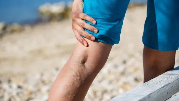 Varicose veins