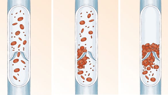 Pathogenesis of thrombosis in pregnancy